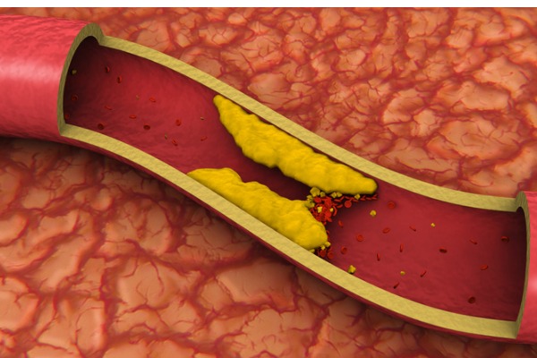 diabetes en verstopte aders